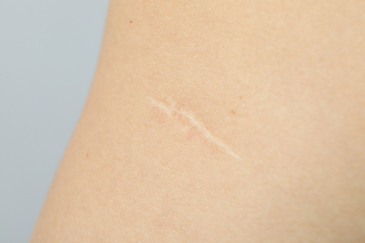 Skin of young man with scar, close up